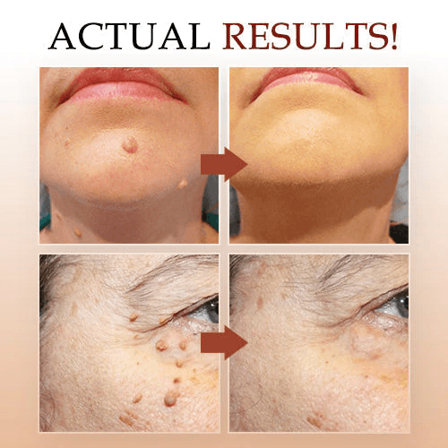 🎁BUY 1 GET 1 FREE🎁WipeOff™ Tags & Moles Remover