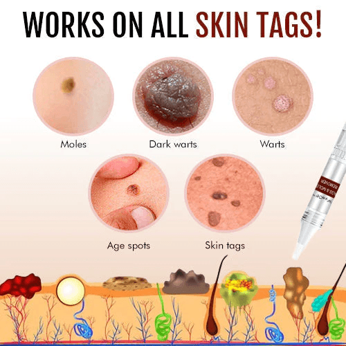 🎁BUY 1 GET 1 FREE🎁WipeOff™ Tags & Moles Remover
